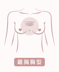 雞胸胸型