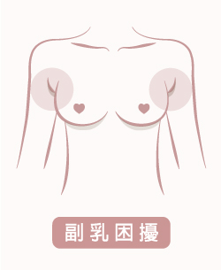 副乳困擾